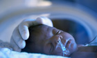 Premature birth stunts brain growth